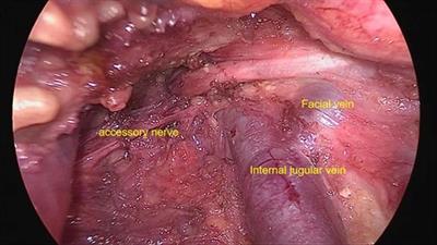 Comparison of surgical outcomes between patients undergoing trans-oral endoscopic thyroid surgery combined with trans-thoracoareolar approach and conventional open surgery